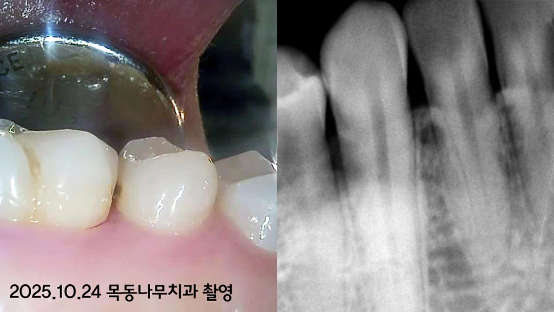 구강 카메라와 포터블 엑스레이 사진
